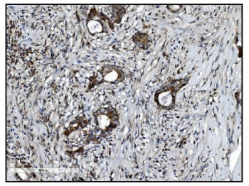 IHC staining of FFPE human breast cancer with VAMP4 antibody. HIER: boil tissue sections in pH8 EDTA