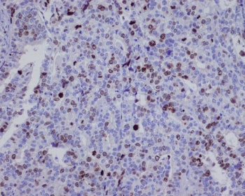 IHC staining of FFPE human ovarian cancer with BIRC5 antibody. HIER: boil tissue sections in pH6, 10