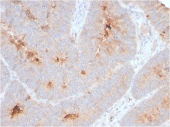 IHC staining of FFPE human colon carcinoma with recombinant ECM1 antibody. HIER: boil tissue section
