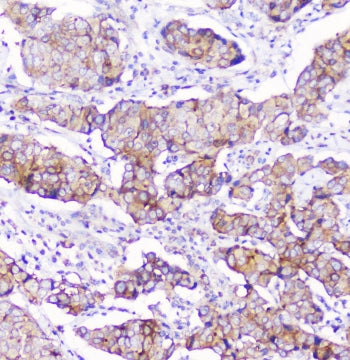 IHC staining of FFPE human breast cancer with CD2AP antibody at 1ug/ml. HIER: boil tissue sections i