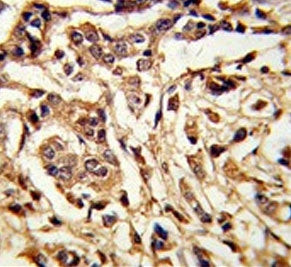 IHC testing of FFPE human breast carcinoma tissue with Galactose-1-phosphate uridylyltransferase ant