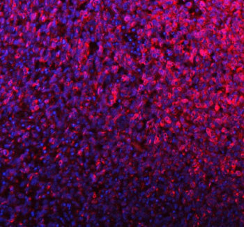 Immunofluorescent staining of SILV/PMEL using anti-PMEL antibody (red). SILV/PMEL was detected in a 