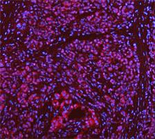Immunofluorescent staining of FFPE human pancreas cancer tissue with DEAD box protein 1 antibody. HI