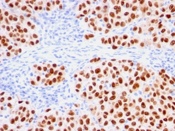 IHC testing of FFPE human melanoma with recombinant SOX10 antibody (clone rSOX10/1074). Required HIE