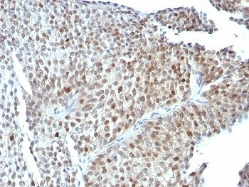 IHC: Formalin-fixed, paraffin-embedded human bladder carcinoma stained with anti-p53 antibody (clone