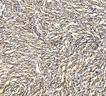 IHC staining of FFPE human glioma tissue with GRID2 antibody. HIER: boil tissue sections in pH8 EDTA