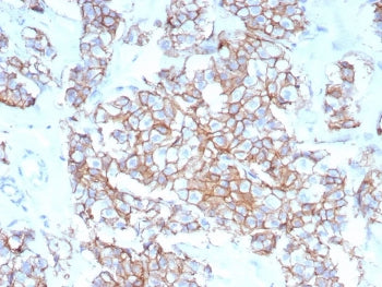IHC staining of FFPE human breast carcinoma tissue with recombinant HER-2 antibody (clone rERBB2/940