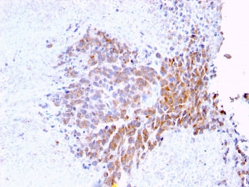 IHC testing of FFPE human melanoma with TOP1MT antibody (clone TOP1MT/568). HIER: boil tissue sectio