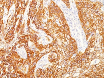 IHC testing of FFPE human lung squamous cell carcinoma with recombinant EGFRvIII antibody (clone GFR