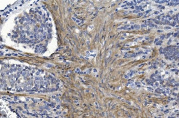 IHC staining of FFPE human gastric cancer with CRYAB antibody. HIER: boil tissue sections in pH8 EDT