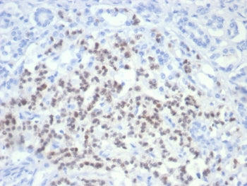 IHC staining of FFPE human pancreatic cancer with PAX6 antibody (clone PAX6/7705). HIER: boil tissue