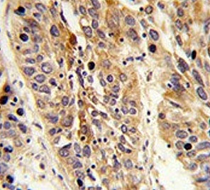 IHC testing of FFPE human lung carcinoma tissue with Leucine-rich alpha-2-glycoprotein antibody. HIE