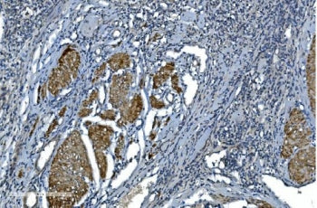 IHC staining of FFPE human bladder cancer with ACTA1 antibody. HIER: boil tissue sections in pH8 EDT
