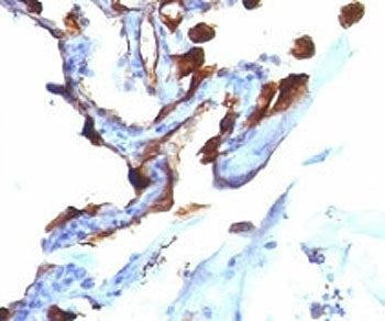 IHC analysis of formalin-fixed, paraffin-embedded human lung carcinoma stained with Cytokeratin 8/18