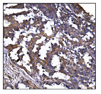 IHC staining of FFPE human ovarian cancer tissue with POGLUT1 antibody. HIER: boil tissue sections i