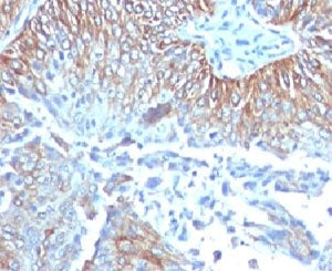 IHC testing of FFPE human esophageal carcinoma and TRIM29 antibody (clone TPMP29-1). FFPE testing re