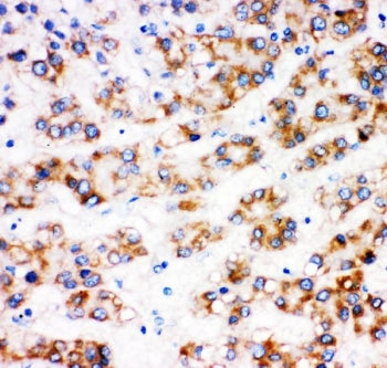 IHC staining of FFPE human liver cancer tissue with AFP antibody. HIER: boil tissue sections in pH6 