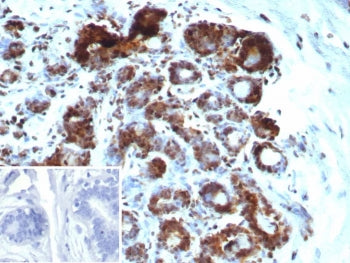 IHC staining of FFPE human breast carcinoma tissue with recombinant BRCA1-Associated Protein 1 antib