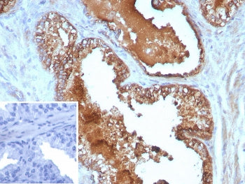 IHC staining of FFPE human prostate cancer tissue with Interleukin 10 antibody (clone IL10/8711). In