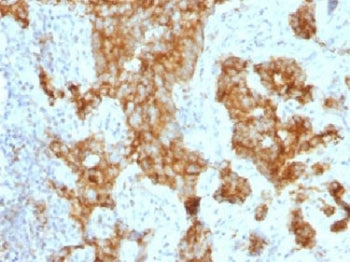 IHC testing of FFPE human prostate carcinoma with CD11c antibody (clone ITGAX/1243). <I>Note stainin