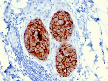 IHC staining of FFPE human breast carcinoma with HER-2 antibody (clone ERBB2/3080). HIER: boil tissu