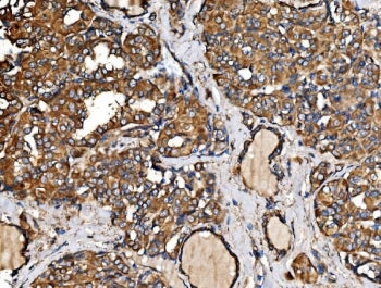 IHC staining of FFPE human thyroid papillary carcinoma tissue with IRBIT antibody. HIER: boil tissue