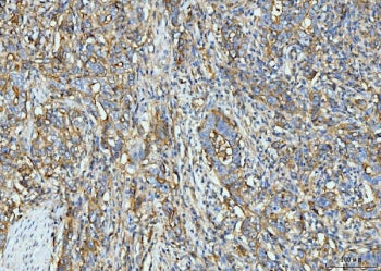 IHC staining of FFPE human rectal moderately differentiated adenocarcinoma tissue with Intercellular