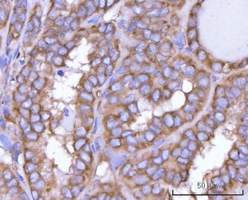 IHC staining of FFPE human thyroid papillary carcinoma tissue with NANP antibody. HIER: boil tissue 