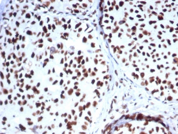 IHC staining of FFPE human breast carcinoma tissue with HSP70-2 antibody (clone HSPA1B/7625). HIER: 