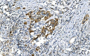 IHC staining of FFPE human bladder cancer with DNM1L antibody. HIER: boil tissue sections in pH8 EDT