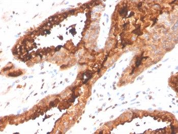 IHC staining of FFPE human prostate carcinoma tissue with Prostatic acid phosphatase antibody (clone