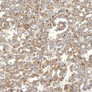 IHC staining of FFPE human thyroid papillary carcinoma tissue with SLC20A1 antibody. HIER: boil tiss