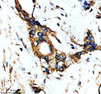 IHC staining of FFPE human pancreatic cancer tissue with YWHAQ antibody, HRP-secondary and DAB subst