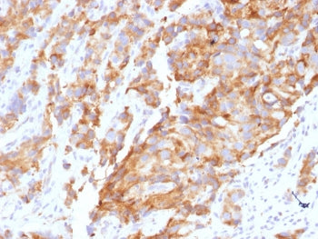 IHC staining of FFPE human prostate carcinoma with Aurora B antibody (clone AURKB/1592). HIER: boil 