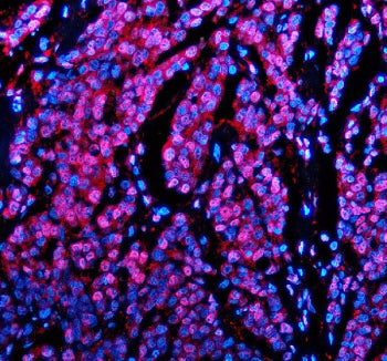 Immunofluorescent staining of PABPN1 using anti-PABPN1 antibody (red). PABPN1 was detected in a para