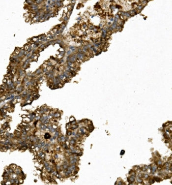 IHC staining of FFPE human renal cancer with Renin antibody. HIER: boil tissue sections in pH8 EDTA 