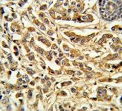 IHC testing of FFPE human breast carcinoma tissue with Steroid 21-hydroxylase antibody. HIER: steam 