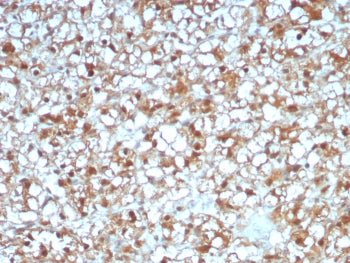 IHC staining of FFPE human renal cell carcinoma tissue with ADH1L1 antibody (clone ALDH1L1/7969). HI