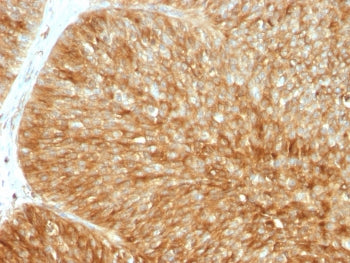 IHC testing of FFPE human bladder carcinoma stained with recombinant B2M antibody (B2M/1857R). Requi
