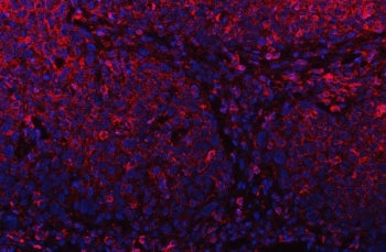 Immunofluorescent staining of FFPE human esophagus squama cancer tissue with PLD6 antibody (red) and