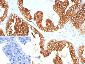 IHC staining of FFPE human prostate carcinoma tissue with KRT5/6 antibody (clone KRT5.6/9104). Inset