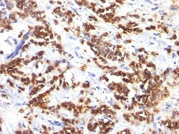 IHC analysis of formalin-fixed, paraffin-embedded human breast carcinoma stained with MFGE8 antibody