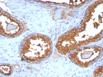 IHC staining of FFPE human prostate carcinoma tissue with PSAP antibody (clone ACPP/8409R). HIER: bo
