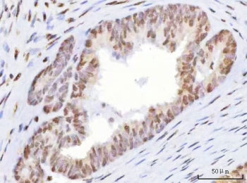 IHC staining of FFPE human mucinous adenoma of the ovary with HOXD10 antibody. HIER: boil tissue sec