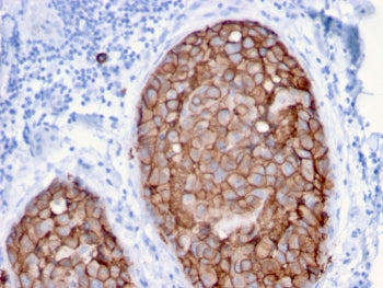 IHC staining of FFPE human breast carcinoma with HER2 antibody (clone ERBB2/3079). HIER: boil tissue