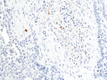 IHC staining of FFPE human lung squamous carcinoma tissue with recombinant Granzyme B antibody at 1: