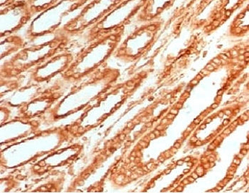IHC testing of FFPE human renal cell carcinoma with Calnexin antibody (clone CLNXN-1). HIER: boil ti