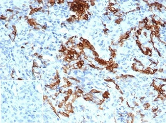 IHC staining of FFPE human melanoma tissue with NGFR/TNFRSF16 antibody (clone NGFR/4919) at 2ug/ml. Negative control inset: PBS used instead of primary antibody to control for secondary Ab binding. HIER: boil tissue sections in pH 9 10mM Tris with 1mM EDTA for 20 min and allow to cool before testing.