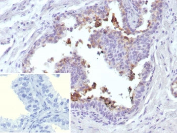 IHC staining of FFPE human prostate cancer tissue with ABCC4 antibody (clone ABCC4/9018). Inset: PBS