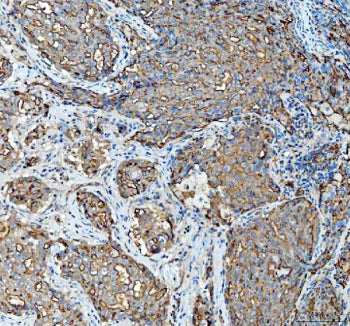 Immunohistochemical staining of FFPE human invasive adenocarcinoma of the lung tissue with Mucin 1 a